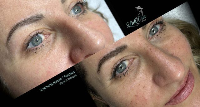 Sommersprossen Freckles Thun Bern Tatoo Pigmentierung